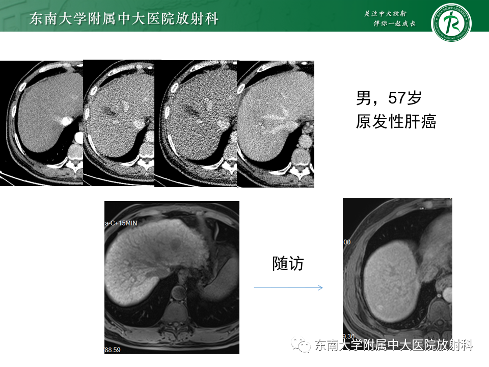 影像PPT - 【PPT】肝硬化结节和早期肝癌的MRI诊断和鉴别-15