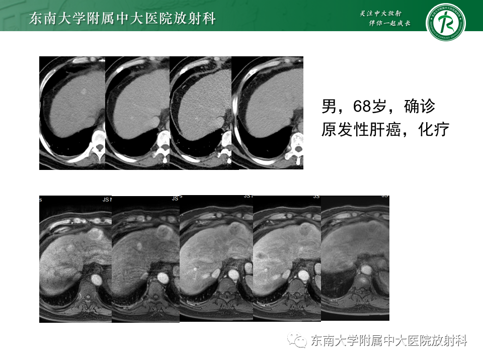 影像PPT - 【PPT】肝硬化结节和早期肝癌的MRI诊断和鉴别-21