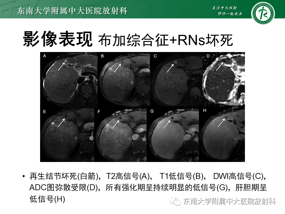 影像PPT - 【PPT】肝硬化结节和早期肝癌的MRI诊断和鉴别-25