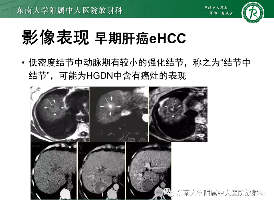 影像PPT - 【PPT】肝硬化结节和早期肝癌的MRI诊断和鉴别-23