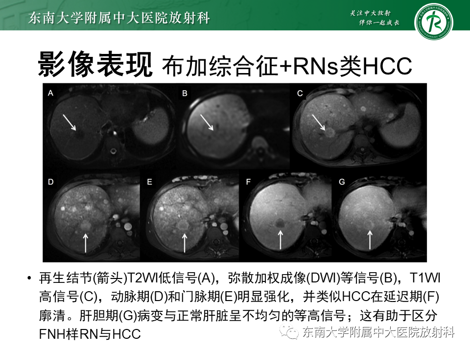 影像PPT - 【PPT】肝硬化结节和早期肝癌的MRI诊断和鉴别-27