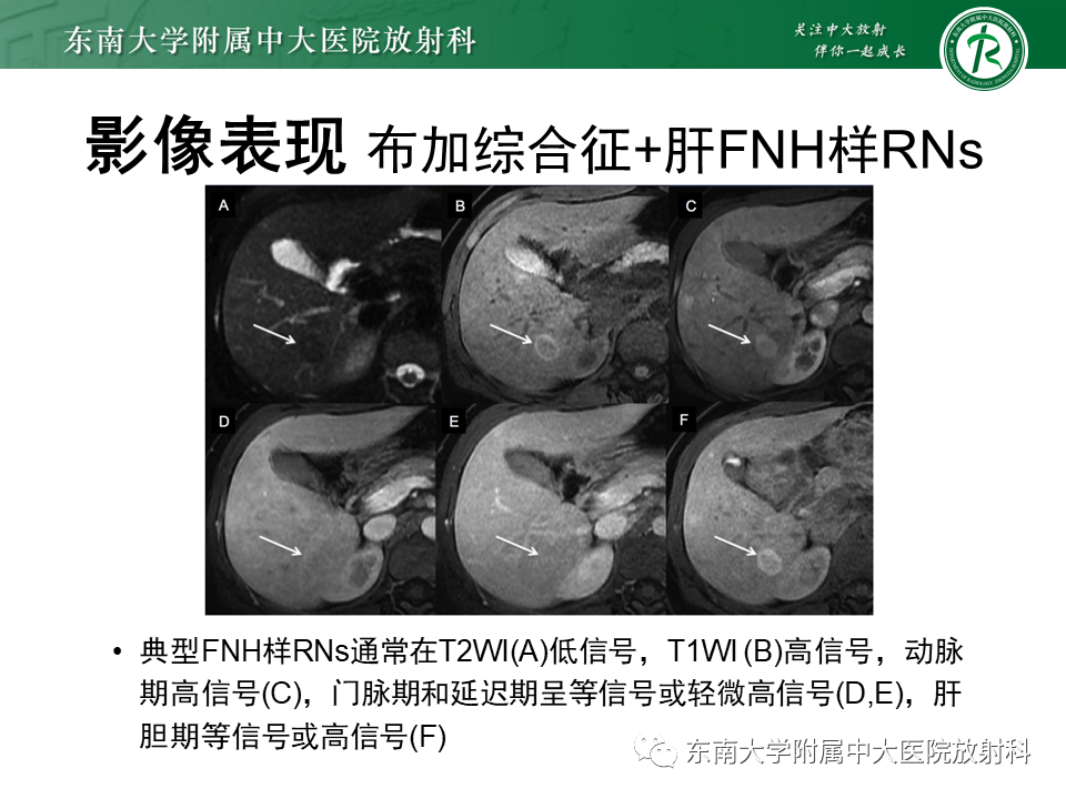 影像PPT - 【PPT】肝硬化结节和早期肝癌的MRI诊断和鉴别-26