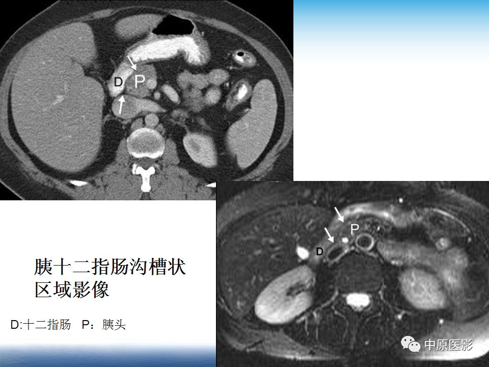 影像PPT - 【PPT】沟槽胰腺炎的影像学诊断与鉴别诊断-3