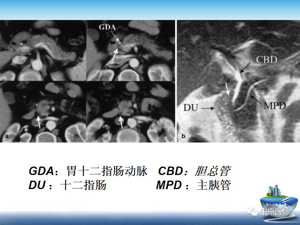 影像PPT - 【PPT】沟槽胰腺炎的影像学诊断与鉴别诊断-4