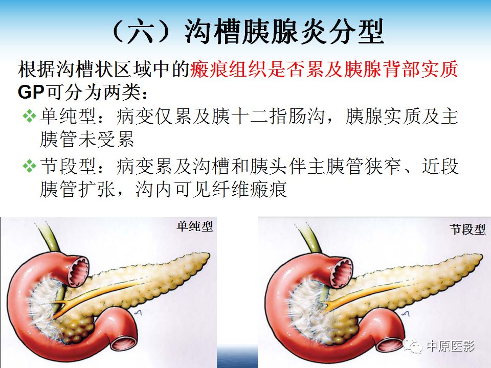 影像PPT - 【PPT】沟槽胰腺炎的影像学诊断与鉴别诊断-11