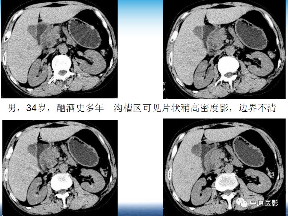 影像PPT - 【PPT】沟槽胰腺炎的影像学诊断与鉴别诊断-13