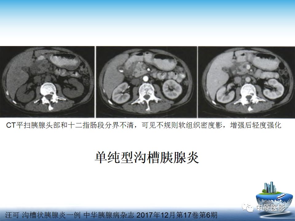 影像PPT - 【PPT】沟槽胰腺炎的影像学诊断与鉴别诊断-14