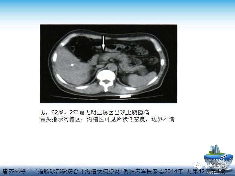 影像PPT - 【PPT】沟槽胰腺炎的影像学诊断与鉴别诊断-15