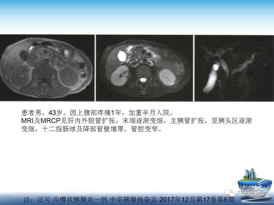 影像PPT - 【PPT】沟槽胰腺炎的影像学诊断与鉴别诊断-17