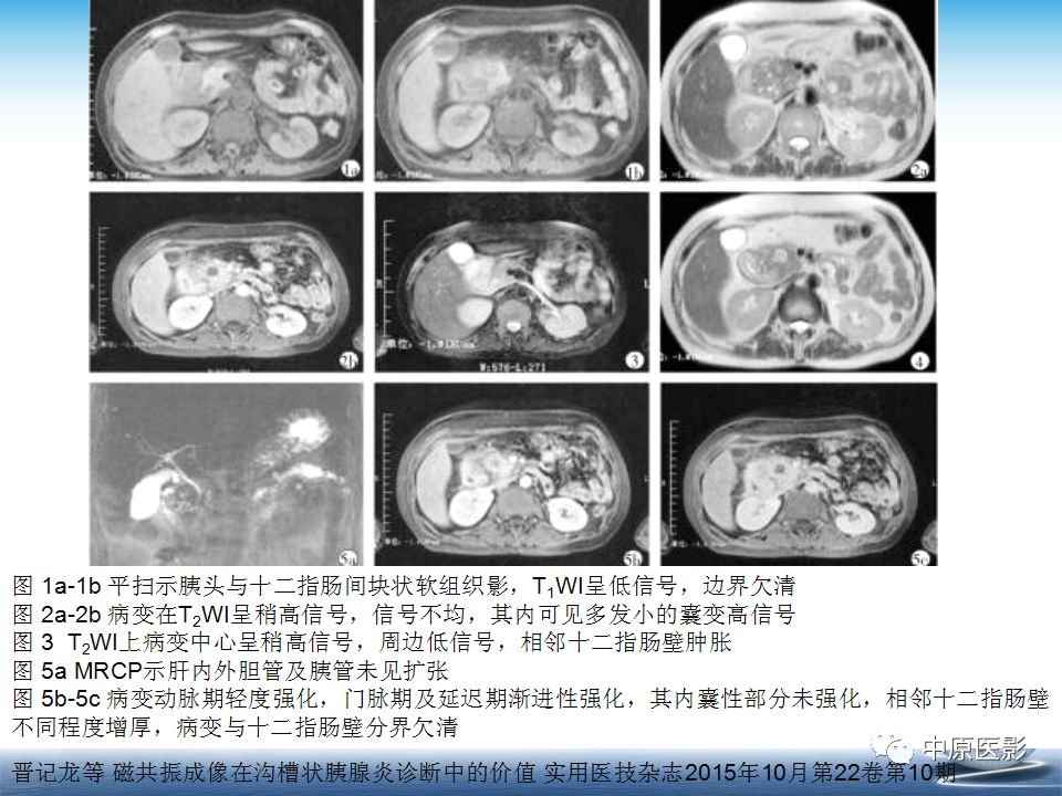 影像PPT - 【PPT】沟槽胰腺炎的影像学诊断与鉴别诊断-18