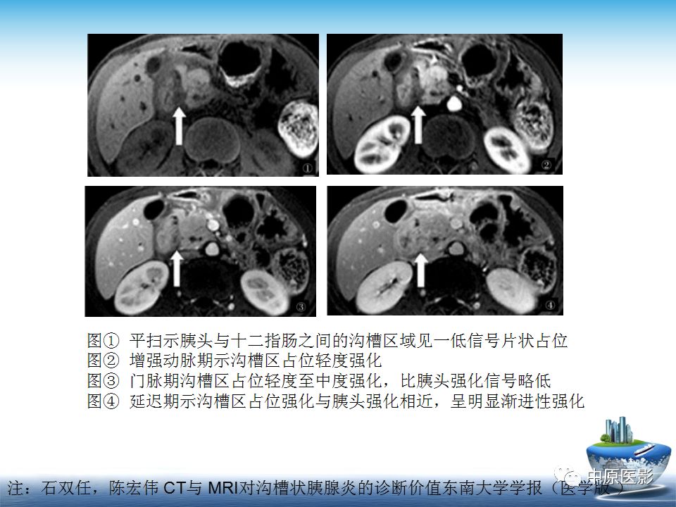 影像PPT - 【PPT】沟槽胰腺炎的影像学诊断与鉴别诊断-19