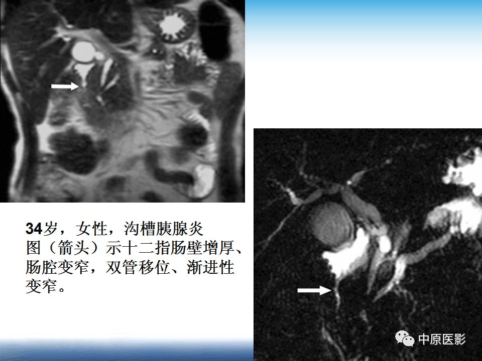 影像PPT - 【PPT】沟槽胰腺炎的影像学诊断与鉴别诊断-21
