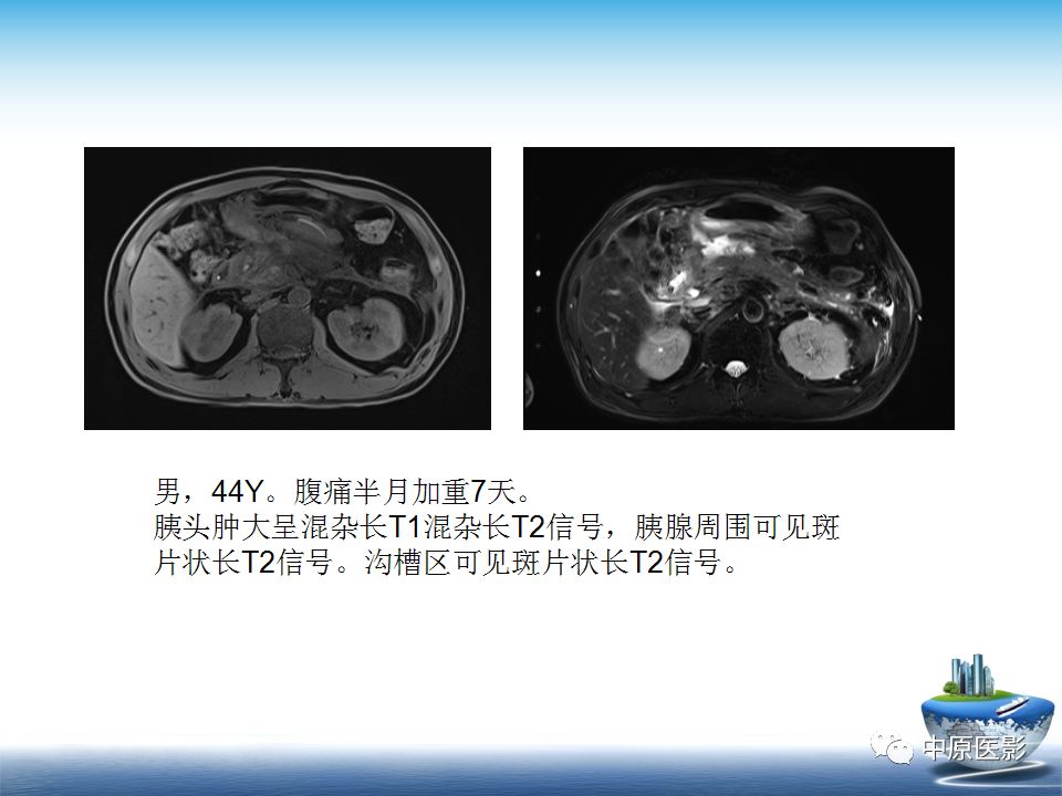 影像PPT - 【PPT】沟槽胰腺炎的影像学诊断与鉴别诊断-23