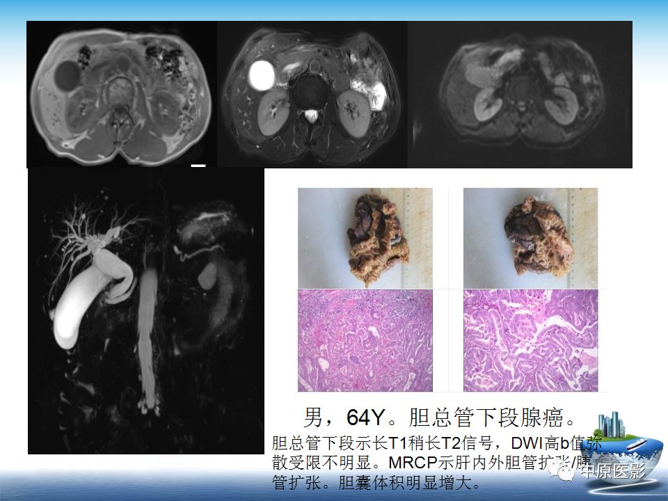 影像PPT - 【PPT】沟槽胰腺炎的影像学诊断与鉴别诊断-25