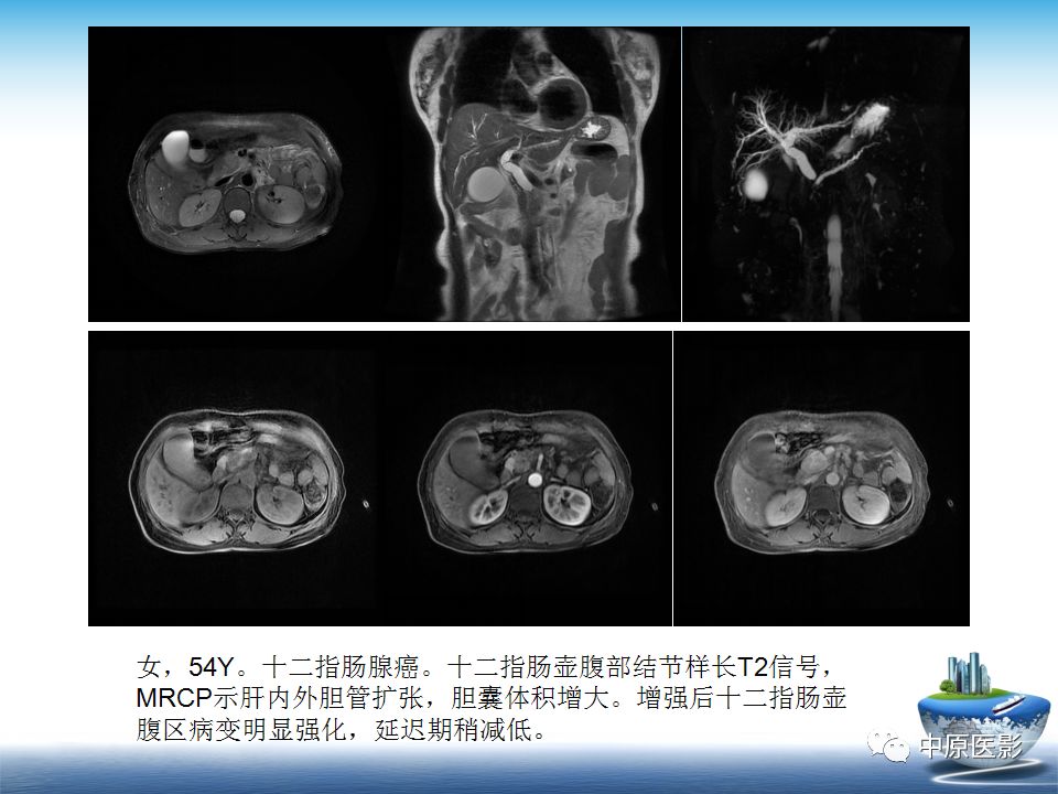 影像PPT - 【PPT】沟槽胰腺炎的影像学诊断与鉴别诊断-27