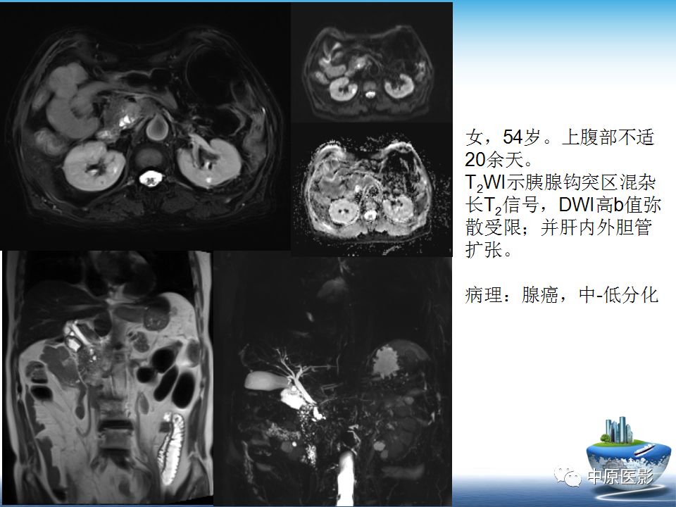 影像PPT - 【PPT】沟槽胰腺炎的影像学诊断与鉴别诊断-29