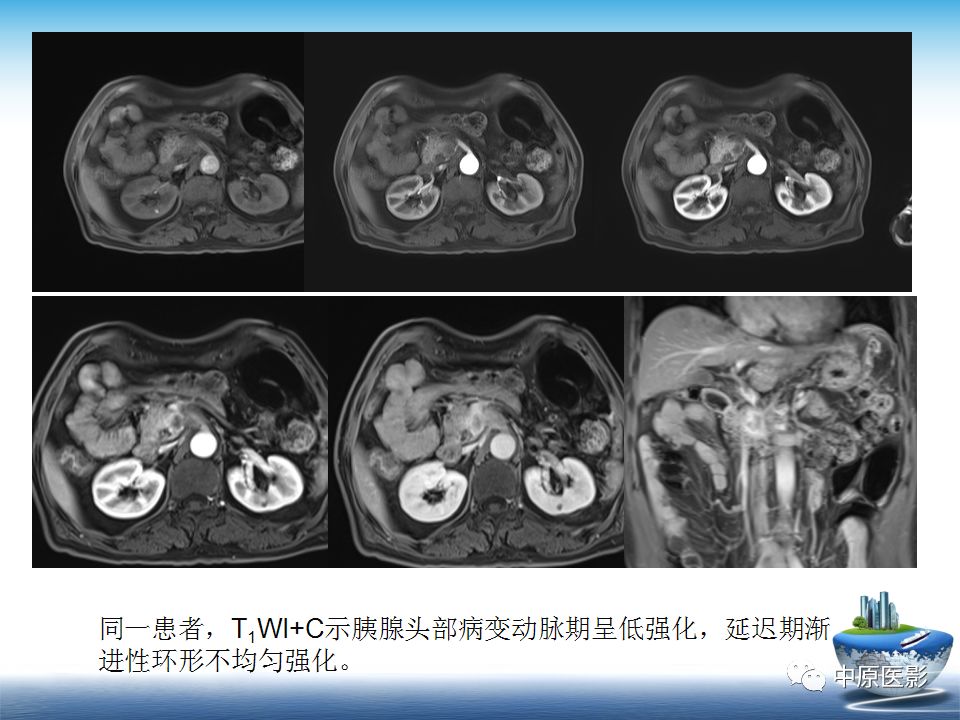 影像PPT - 【PPT】沟槽胰腺炎的影像学诊断与鉴别诊断-30
