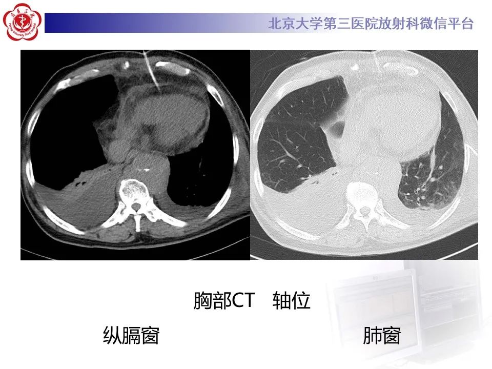 影像PPT - 【PPT】主动脉周围淋巴瘤-3