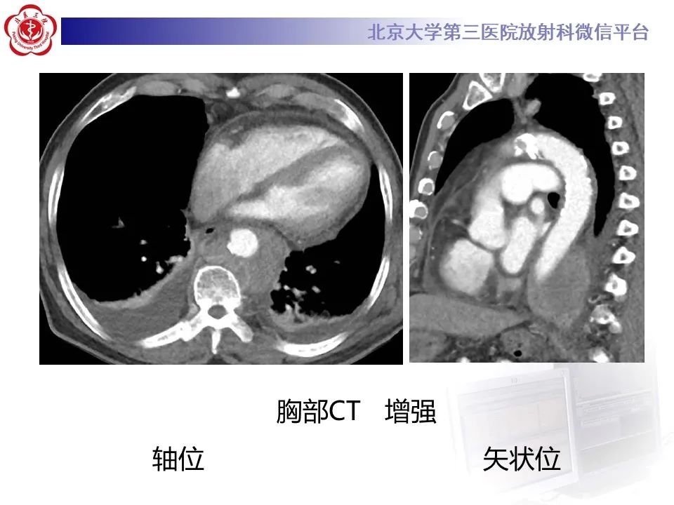 影像PPT - 【PPT】主动脉周围淋巴瘤-4