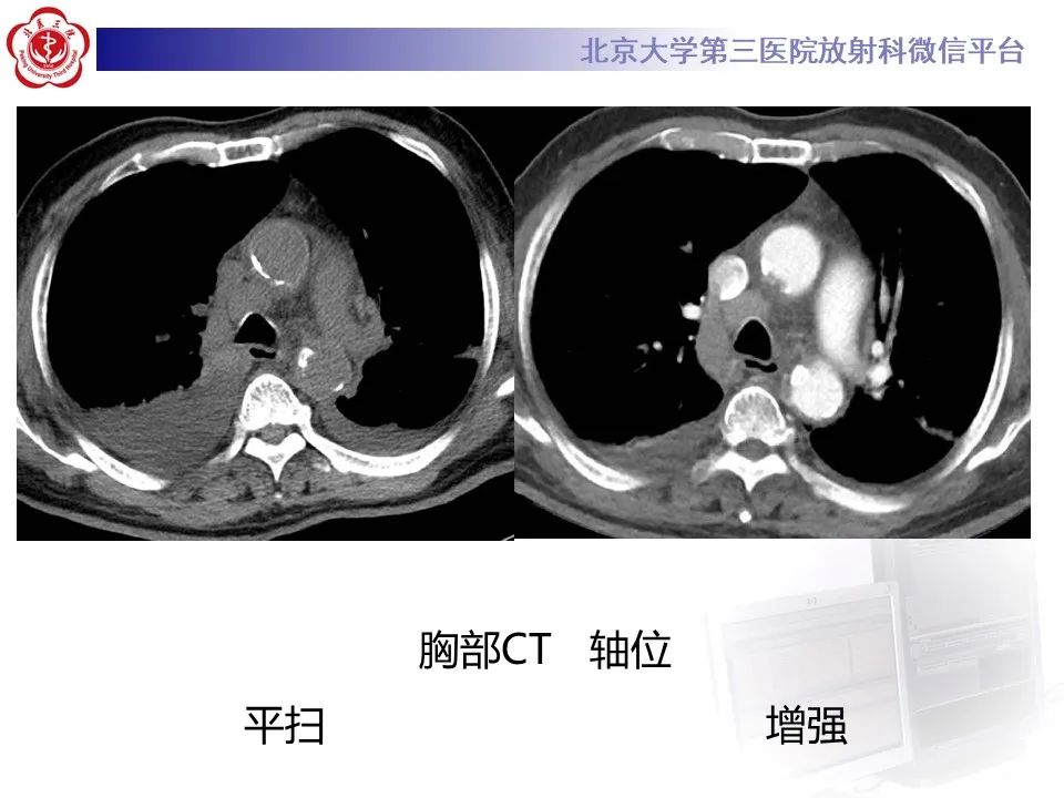 影像PPT - 【PPT】主动脉周围淋巴瘤-5
