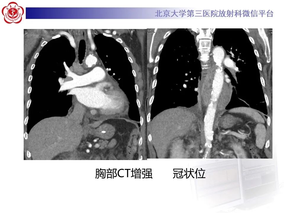 影像PPT - 【PPT】主动脉周围淋巴瘤-6