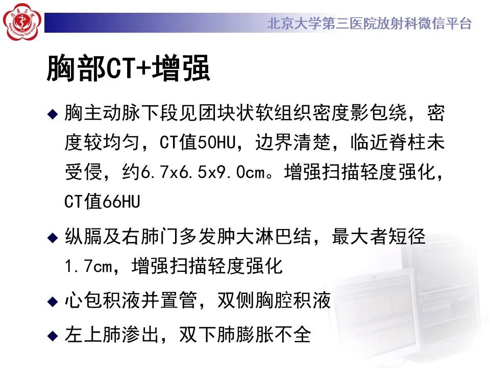 影像PPT - 【PPT】主动脉周围淋巴瘤-7