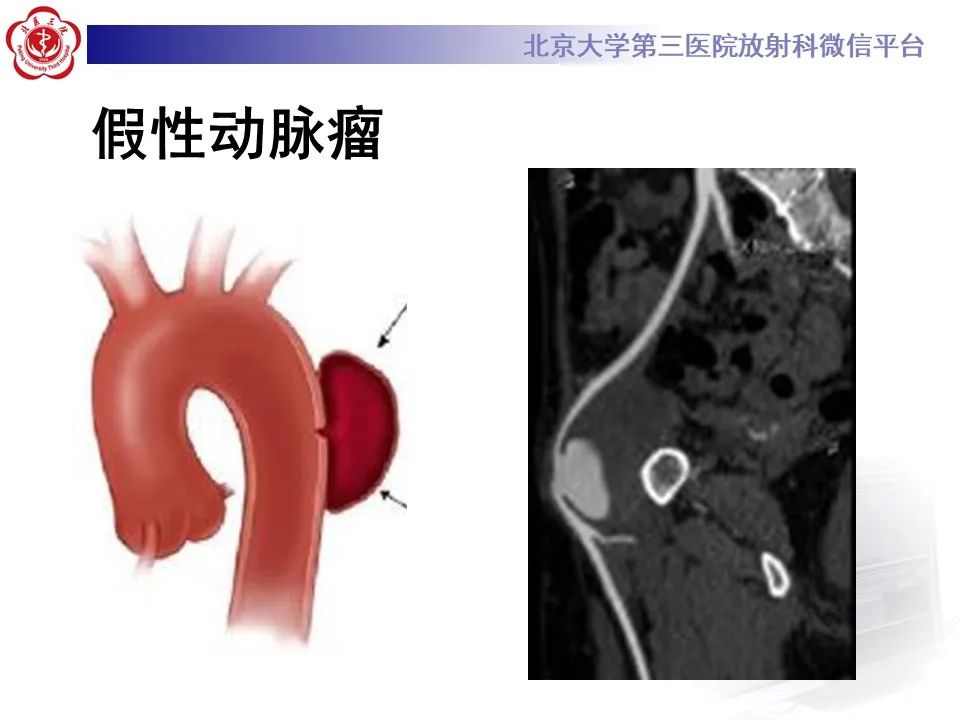 影像PPT - 【PPT】主动脉周围淋巴瘤-10