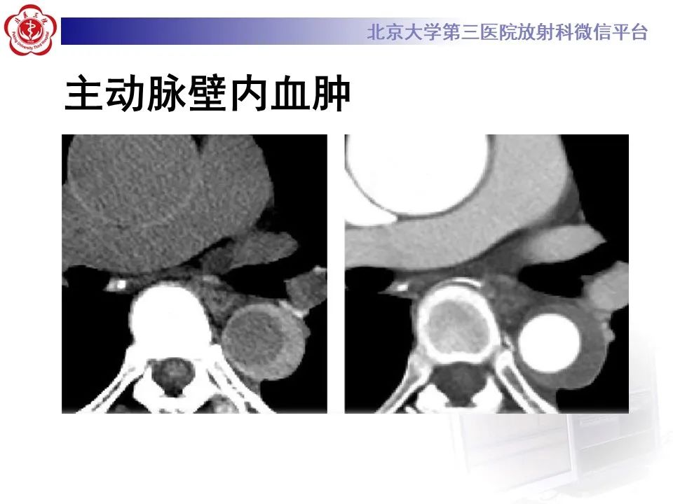 影像PPT - 【PPT】主动脉周围淋巴瘤-9
