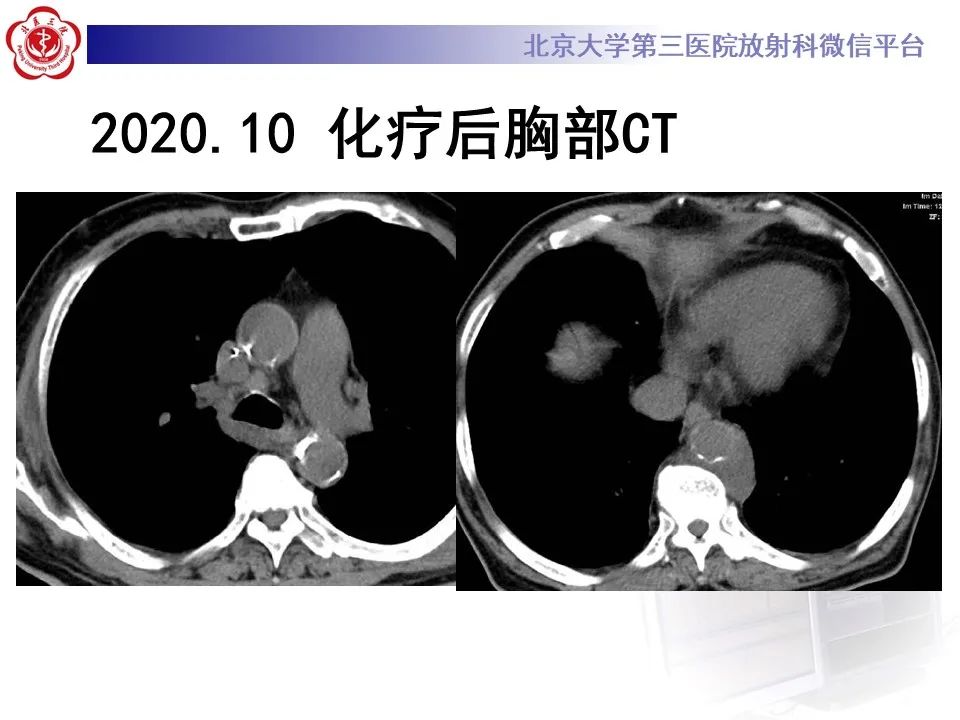 影像PPT - 【PPT】主动脉周围淋巴瘤-13