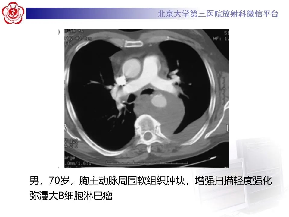 影像PPT - 【PPT】主动脉周围淋巴瘤-18