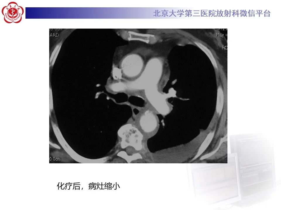 影像PPT - 【PPT】主动脉周围淋巴瘤-19
