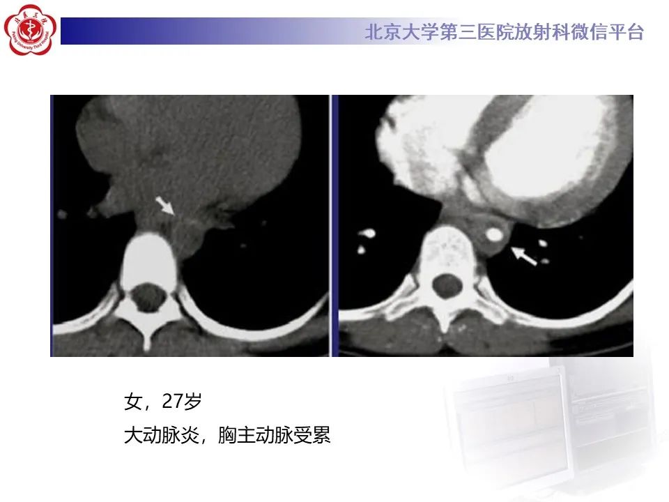 影像PPT - 【PPT】主动脉周围淋巴瘤-21