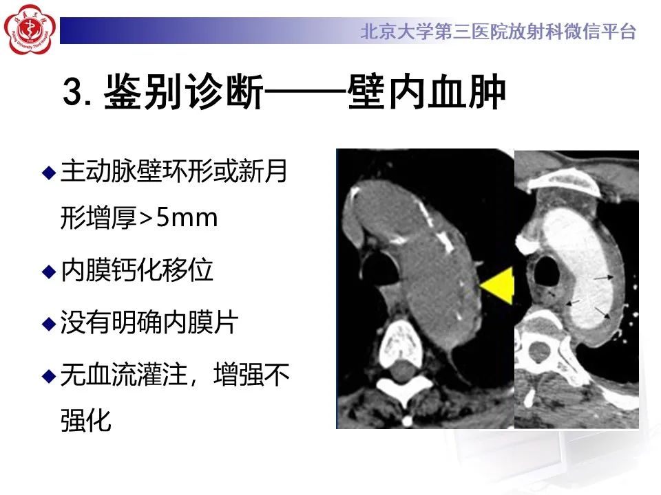 影像PPT - 【PPT】主动脉周围淋巴瘤-22