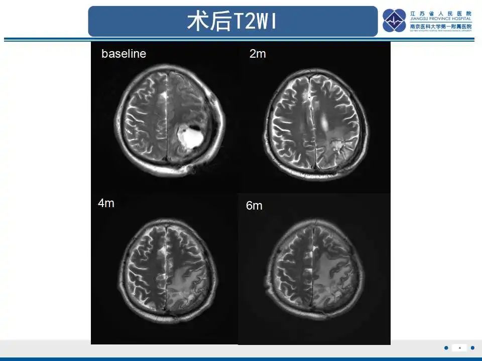 影像PPT - 【PPT】胶质瘤治疗后假性进展-5