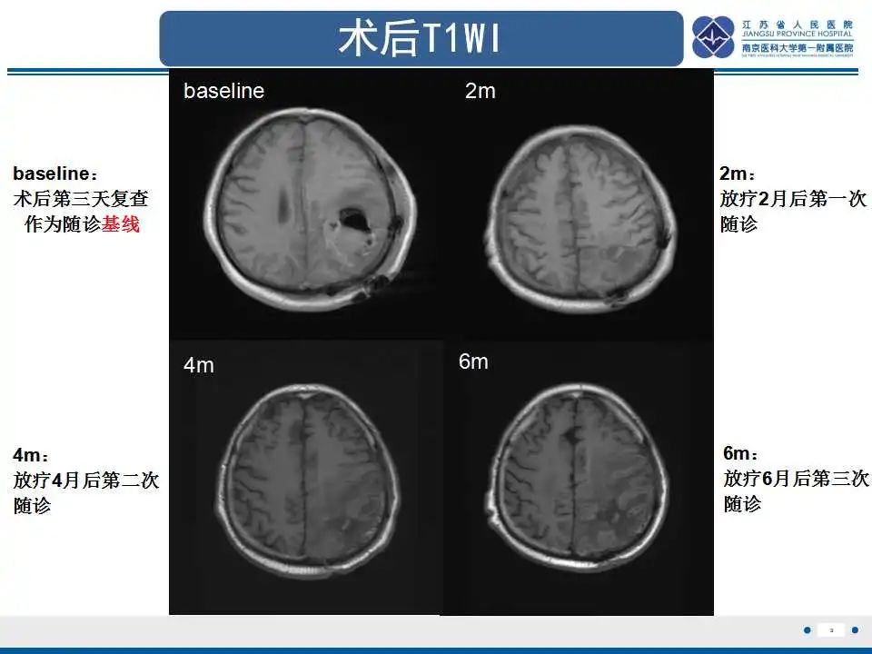 影像PPT - 【PPT】胶质瘤治疗后假性进展-4