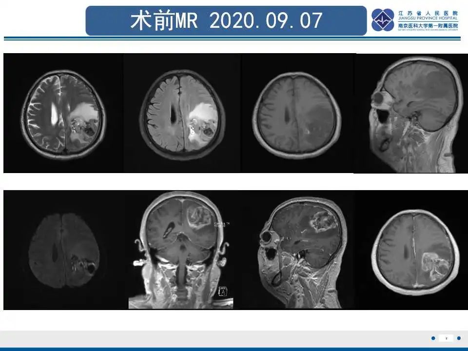影像PPT - 【PPT】胶质瘤治疗后假性进展-3