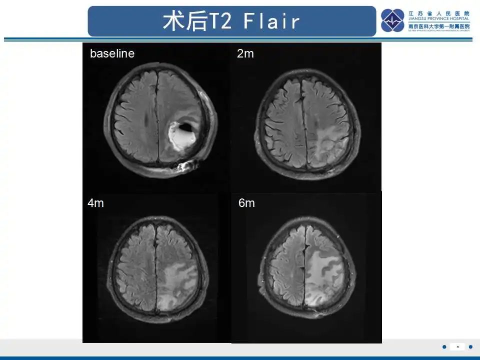 影像PPT - 【PPT】胶质瘤治疗后假性进展-6