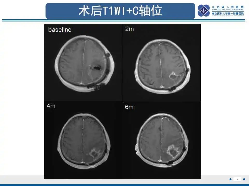 影像PPT - 【PPT】胶质瘤治疗后假性进展-8
