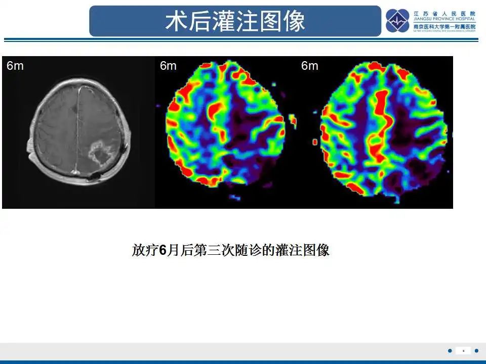影像PPT - 【PPT】胶质瘤治疗后假性进展-9