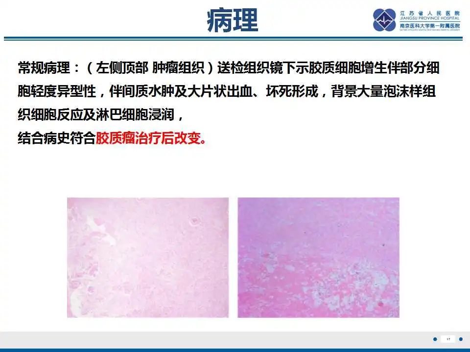 影像PPT - 【PPT】胶质瘤治疗后假性进展-18