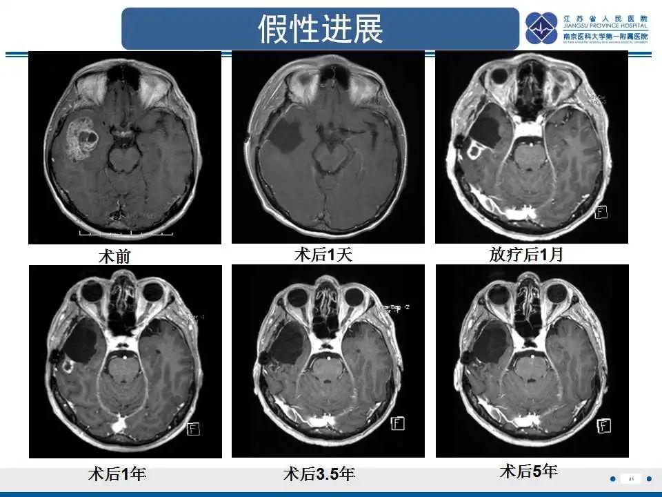 影像PPT - 【PPT】胶质瘤治疗后假性进展-22