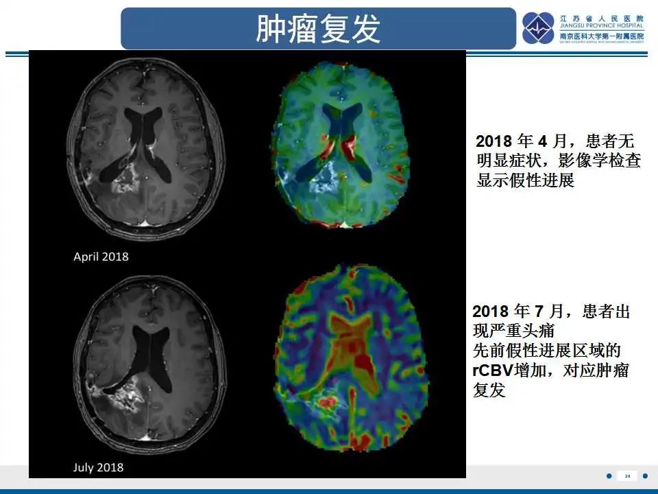 影像PPT - 【PPT】胶质瘤治疗后假性进展-29