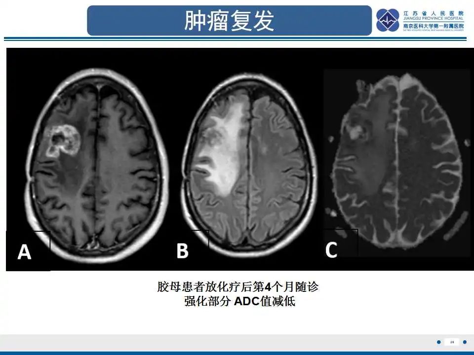 影像PPT - 【PPT】胶质瘤治疗后假性进展-27