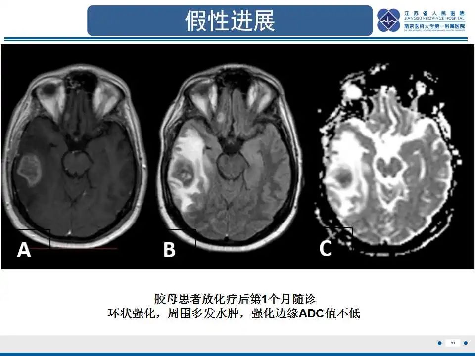 影像PPT - 【PPT】胶质瘤治疗后假性进展-26