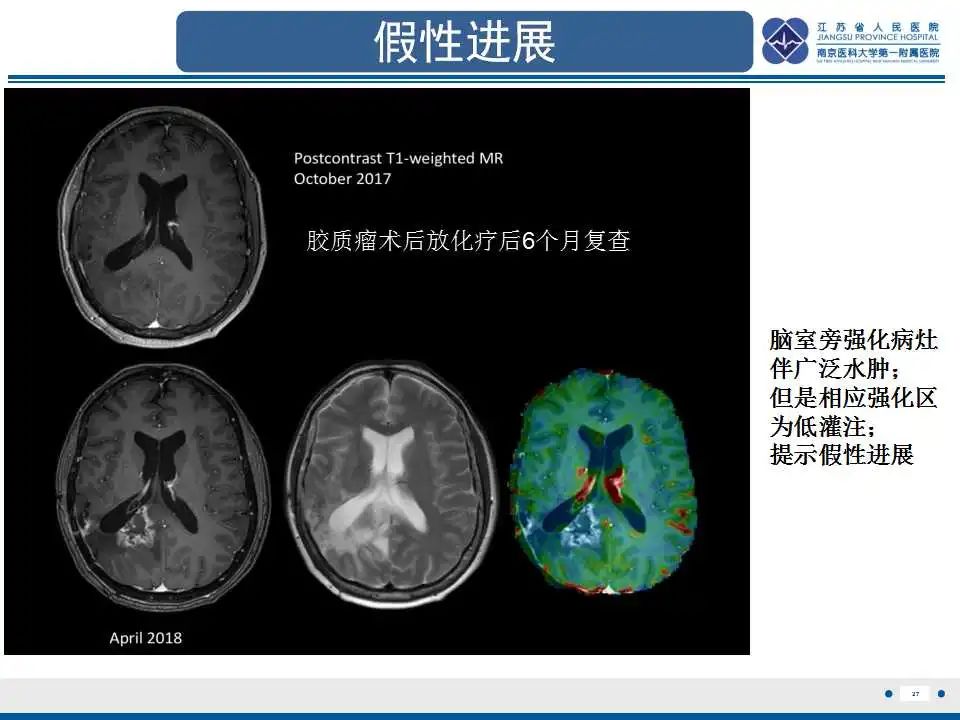 影像PPT - 【PPT】胶质瘤治疗后假性进展-28