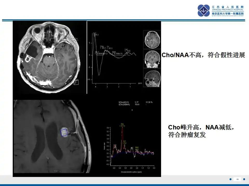 影像PPT - 【PPT】胶质瘤治疗后假性进展-30
