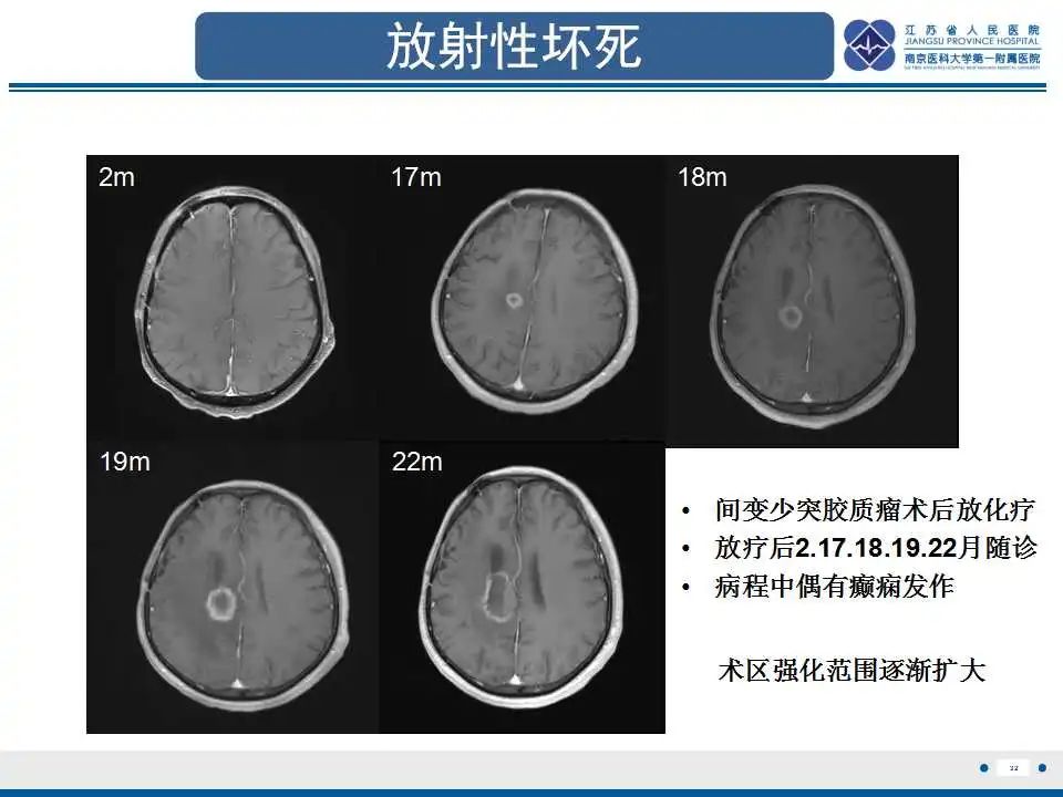影像PPT - 【PPT】胶质瘤治疗后假性进展-33