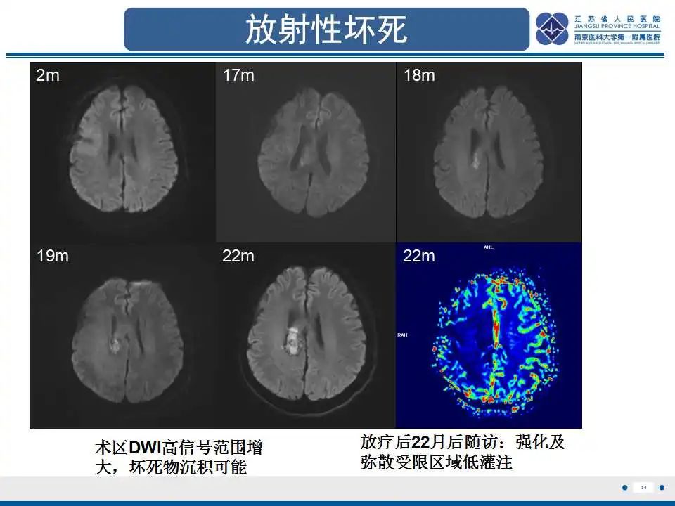 影像PPT - 【PPT】胶质瘤治疗后假性进展-35
