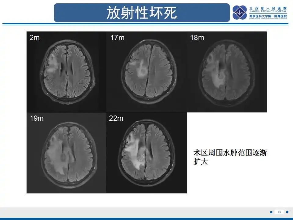 影像PPT - 【PPT】胶质瘤治疗后假性进展-34