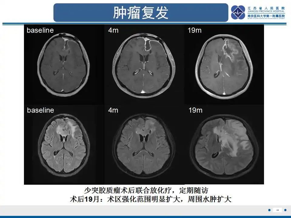 影像PPT - 【PPT】胶质瘤治疗后假性进展-37
